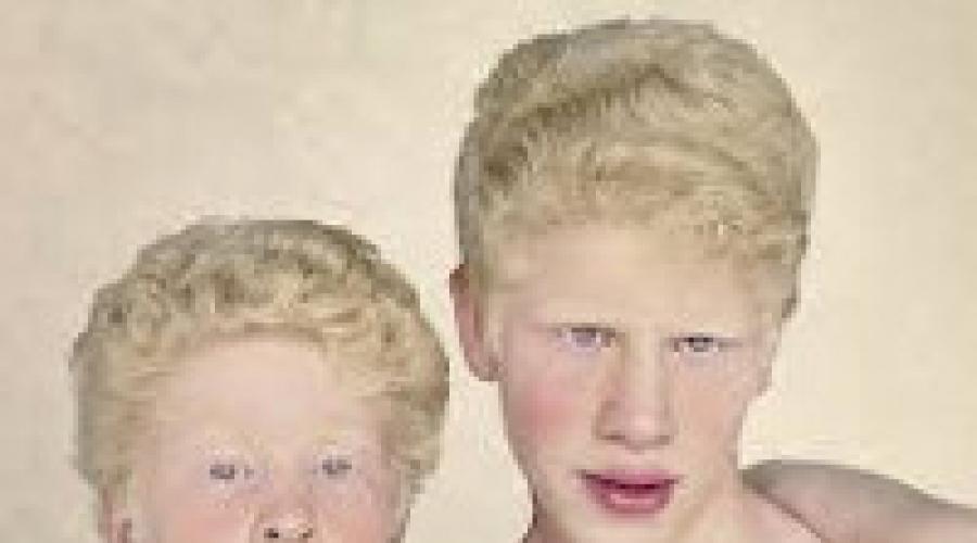 albínó emberek látási problémák