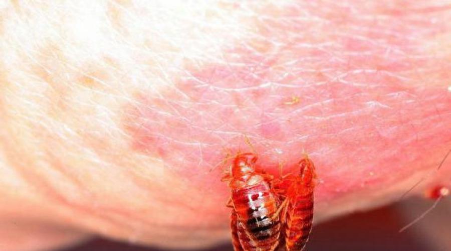 Bed bugs and their bites.  Bed bug bites on a person.  Treating a severe allergic reaction