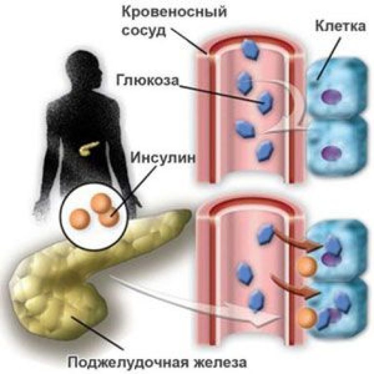 nesposobnost hipertenzije i dijabetesa)