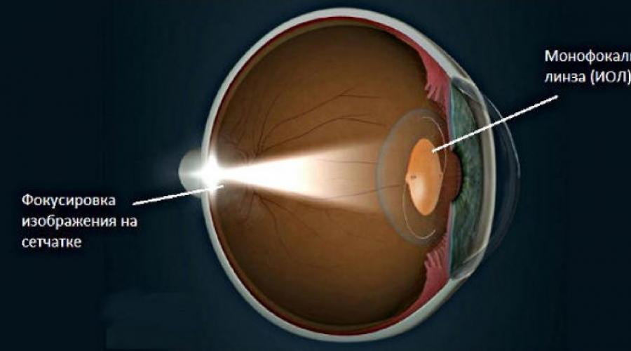 Интраокулярные линзы для замены хрусталика глаза. ИОЛ - интраокулярные линзы (искусственные хрусталики) Немецкие хрусталики для глаз