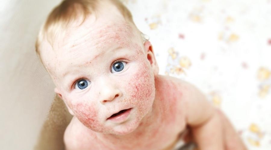 Jak leczyć zapalenie skóry u dziecka na ciele.  Zapalenie skóry u dzieci: dlaczego występuje, jak wygląda, co jest niebezpieczne i jak je leczyć?  Ogólna zmiana stanu